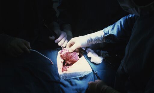 Skrikende behov for organdonorer